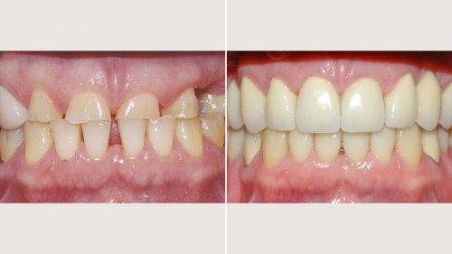 Full mouth reconstruction with crowns and partial dentures