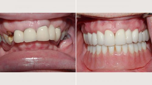 Upper crowns and lower bar and overdenture supported by implants