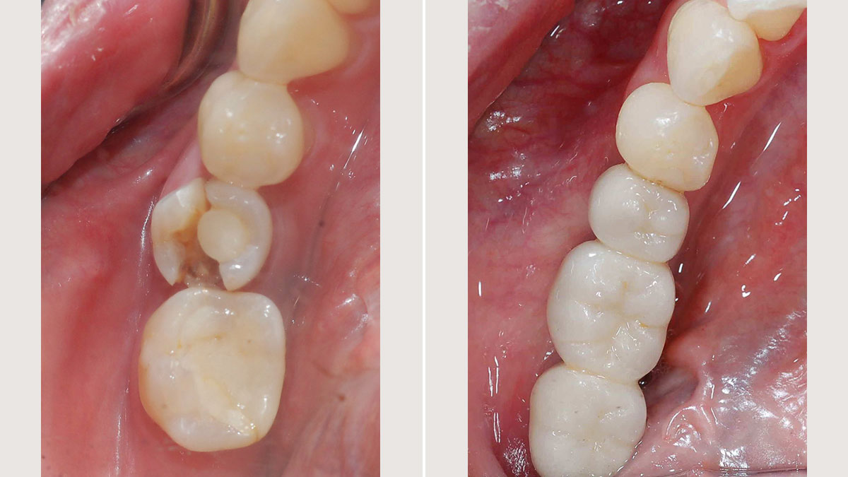Extraction of fractured and failed root canal treated tooth, followed by three splinted implants restored with splinted crowns