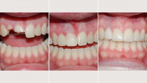 Initial emergency composites followed by implant supported crown and veneers